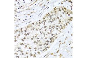 Immunohistochemistry of paraffin-embedded human lung cancer using PGR antibody. (Progesterone Receptor anticorps)