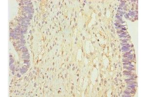 Immunohistochemistry of paraffin-embedded human ovarian cancer using ABIN7146349 at dilution of 1:100 (CALCOCO2 anticorps  (AA 137-446))
