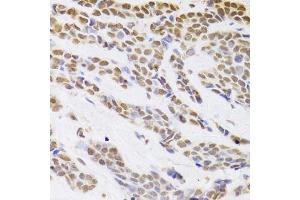 Immunohistochemistry of paraffin-embedded human breast cancer using HDGF Antibody. (HDGF anticorps  (AA 1-240))