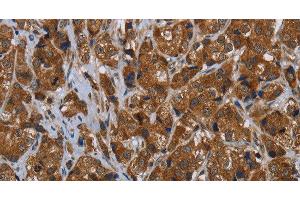 Immunohistochemistry of paraffin-embedded Human breast cancer tissue using ARHGEF12 Polyclonal Antibody at dilution 1:30 (ARHGEF12 anticorps)