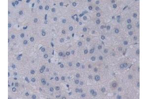 Detection of NRP2 in Human Liver cancer Tissue using Polyclonal Antibody to Neuropilin 2 (NRP2)