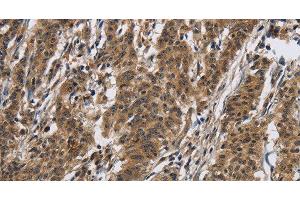 Immunohistochemistry of paraffin-embedded Human gasrtic cancer tissue using IL12RB2 Polyclonal Antibody at dilution 1:40 (IL12RB2 anticorps)