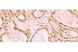 Immunohistochemistry of paraffin-embedded Human thyroid cancer tissue using SETDB1 Polyclonal Antibody at dilution of 1:60(x200)