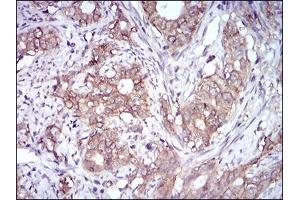 Immunohistochemical analysis of paraffin-embedded cervical cancer tissues using EPCAM mouse mAb with DAB staining. (EpCAM anticorps  (AA 24-265))