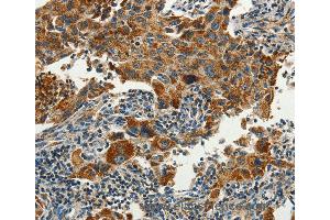 Immunohistochemistry of Human lung cancer using SERPINA9 Polyclonal Antibody at dilution of 1:60 (SERPINA9 anticorps)