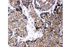 IHC-P: ABCB6 antibody testing of human breast cancer tissue (ABCB6 anticorps  (C-Term))