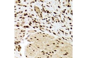 Immunohistochemistry of paraffin-embedded human gastric cancer using ANP32A Antibody.