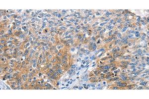 Immunohistochemistry of paraffin-embedded Human ovarian cancer tissue using CGB Polyclonal Antibody at dilution 1:60