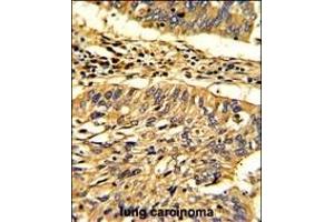 Formalin-fixed and paraffin-embedded human lung carcinoma with Hsp 60 Antibody (N-term), which was peroxidase-conjugated to the secondary antibody, followed by DAB staining.