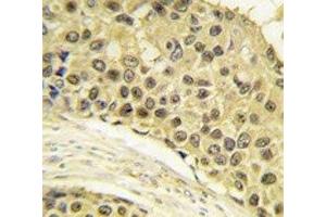 IHC analysis of FFPE human breast carcinoma tissue stained with Cyclin A2 antibody