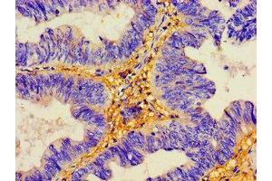 Immunohistochemistry of paraffin-embedded human colon cancer using ABIN7149779 at dilution of 1:100 (Desmoglein 2 anticorps  (AA 183-331))