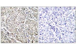 Immunohistochemical analysis of paraffin-embedded human breast carcinoma tissue, using NF-κB p65 (Phospho-Ser529) antibody (E011217). (NF-kB p65 anticorps  (pSer529))