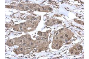 IHC-P Image Immunohistochemical analysis of paraffin-embedded human breast cancer, using VCP, antibody at 1:500 dilution. (VCP anticorps  (C-Term))