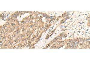 Immunohistochemistry of paraffin-embedded Human liver cancer tissue using IMPA1 Polyclonal Antibody at dilution of 1:25(x200) (IMPA1 anticorps)