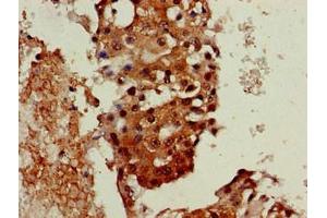 Immunohistochemistry of paraffin-embedded human breast cancer using ABIN7161445 at dilution of 1:100 (Neuroserpin anticorps  (AA 191-240))