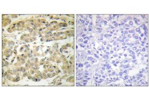 Immunohistochemical analysis of paraffin-embedded human breast carcinoma tissue, using 14-3-3 zeta (phospho-Ser58) antibody. (14-3-3 zeta anticorps  (pSer58))