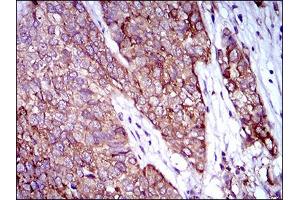 Immunohistochemical analysis of paraffin-embedded bladder cancer tissues using ZFP42 mouse mAb with DAB staining.