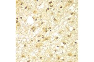 Immunohistochemistry of paraffin-embedded human brain cancer using TBL1XR1 antibody at dilution of 1:100 (x400 lens).