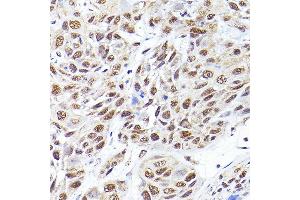Immunohistochemistry of paraffin-embedded human esophageal cancer using SEC14L2 Rabbit pAb (ABIN6132639, ABIN6147484, ABIN6147485 and ABIN6214889) at dilution of 1:200 (40x lens). (SEC14L2 anticorps  (AA 60-270))
