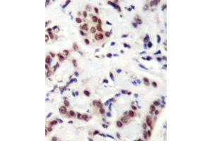 Immunohistochemistry (IHC) image for anti-Signal Transducer and Activator of Transcription 5A (STAT5A) (pTyr694) antibody (ABIN1870647) (STAT5A anticorps  (pTyr694))