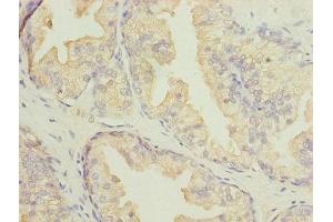 Immunohistochemistry of paraffin-embedded human prostate cancer using ABIN7145131 at dilution of 1:100