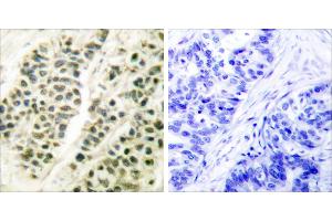 Peptide - +Immunohistochemical analysis of paraffin-embedded human breast carcinoma tissue using DNA Polymerase β antibody (#C0173). (POLB anticorps)