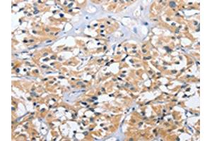 The image on the left is immunohistochemistry of paraffin-embedded Human thyroid cancer tissue using ABIN7131541(UGCG Antibody) at dilution 1/40, on the right is treated with fusion protein. (UGCG anticorps)