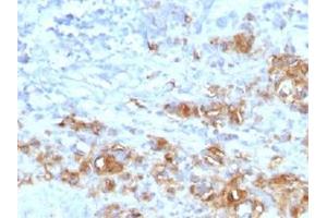 Immunohistochemical staining (Formalin-fixed paraffin-embedded sections) of human gastric carcinoma with CA19-9 recombinant monoclonal antibody, clone CA19. (Recombinant CA 19-9 anticorps)