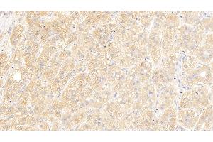 Detection of IGSF1 in Human Liver cancer Tissue using Polyclonal Antibody to Immunoglobulin superfamily, member 1 (IGSF1)