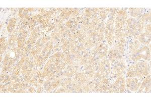 Detection of IGSF1 in Human Liver cancer Tissue using Polyclonal Antibody to Immunoglobulin superfamily, member 1 (IGSF1) (IGSF1 anticorps  (AA 1008-1227))