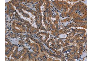 The image on the left is immunohistochemistry of paraffin-embedded Human thyroid cancer tissue using ABIN7130015(KLK13 Antibody) at dilution 1/20, on the right is treated with fusion protein. (Kallikrein 13 anticorps)