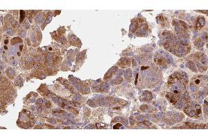 ABIN6273772 at 1/100 staining Human liver cancer tissue by IHC-P. (RIPK1 anticorps  (Internal Region))