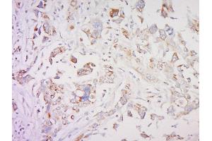 Formalin-fixed and paraffin embedded human breast cancer labeled with SMAD1 Polyclonal Antibody, Unconjugated  at 1:200 followed by conjugation to the secondary antibody and DAB staining