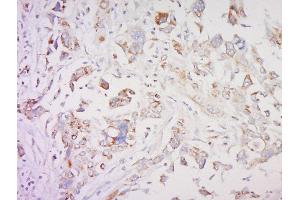 Formalin-fixed and paraffin embedded human breast cancer labeled with SMAD1 Polyclonal Antibody, Unconjugated  at 1:200 followed by conjugation to the secondary antibody and DAB staining (SMAD1 anticorps  (AA 151-250))