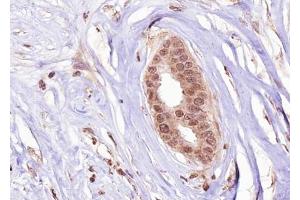 ABIN6267277 at 1/100 staining human Breast carcinoma tissue sections by IHC-P.