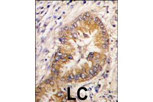 Formalin-fixed and paraffin-embedded human lung carcinoma tissue reacted with CDCA8 polyclonal antibody  , which was peroxidase-conjugated to the secondary antibody, followed by DAB staining. (CDCA8 anticorps  (Internal Region))