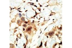 IHC analysis of FFPE human breast carcinoma tissue stained with the Insulin Receptor antibody