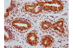 IHC image of ABIN7127714 diluted at 1:100 and staining in paraffin-embedded human breast cancer performed on a Leica BondTM system.