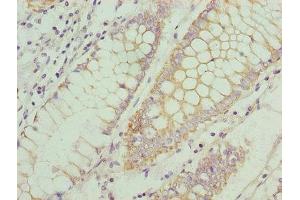 Immunohistochemistry of paraffin-embedded human colon cancer using ABIN7145914 at dilution of 1:100