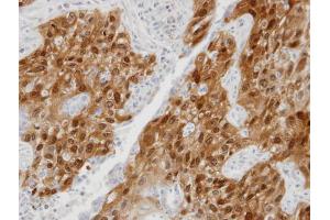 IHC-P Image Immunohistochemical analysis of paraffin-embedded lung SCC xenograft, using DDX5, antibody at 1:100 dilution. (DDX5 anticorps  (C-Term))
