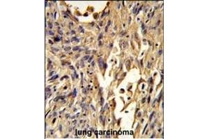 Formalin-fixed and paraffin-embedded human lung carcinoma reacted with S100A10 Antibody (Center), which was peroxidase-conjugated to the secondary antibody, followed by DAB staining. (S100A10 anticorps  (AA 12-40))