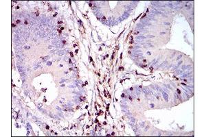 Immunohistochemical analysis of paraffin-embedded colon cancer tissues using PTPRC mouse mAb with DAB staining. (CD45 anticorps  (AA 928-989))