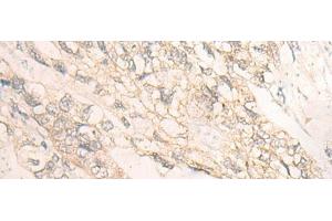 Immunohistochemistry of paraffin-embedded Human gastric cancer tissue using DMTN Polyclonal Antibody at dilution of 1:35(x200) (Dematin anticorps)