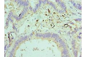 Immunohistochemistry of paraffin-embedded human colon cancer using ABIN7151593 at dilution of 1:100 (TCEB2 anticorps  (AA 1-118))