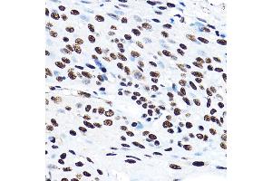Immunohistochemistry of paraffin-embedded human esophageal cancer using SF3 Rabbit pAb (ABIN1682671, ABIN3018959, ABIN3018960 and ABIN6220644) at dilution of 1:100 (40x lens). (SF3A3 anticorps  (AA 292-501))