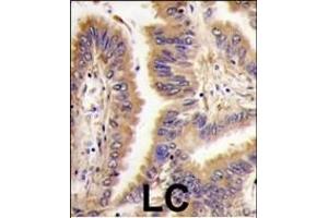 Formalin-fixed and paraffin-embedded human lung carcinoma tissue reacted with *TGM2 antibody (Center ), which was peroxidase-conjugated to the secondary antibody, followed by DAB staining.