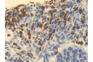 Detection of OTC in Human Esophagus cancer Tissue using Polyclonal Antibody to Ornithine Transcarbamylase (OTC)