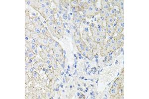 Immunohistochemistry of paraffin-embedded human liver injury using ATP1B1 antibody at dilution of 1:100 (x40 lens). (ATP1B1 anticorps)