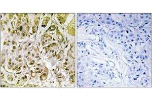 Immunohistochemistry analysis of paraffin-embedded human breast carcinoma, using Smad1 (Phospho-Ser187) Antibody.