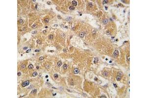 IHC analysis of FFPE human hepatocarcinoma tissue stained with APOA5 antibody